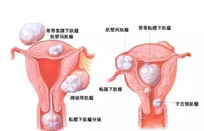 谈瘤色变？子宫肌瘤究竟是什么？ 