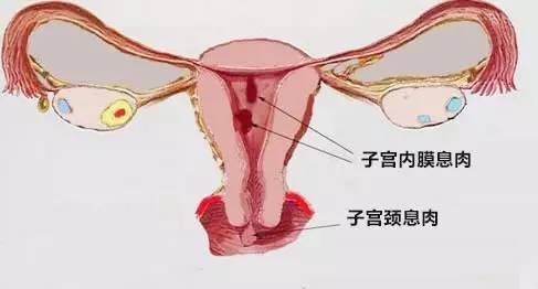 宫颈息肉，30岁—50岁女性的“心中刺”！ 