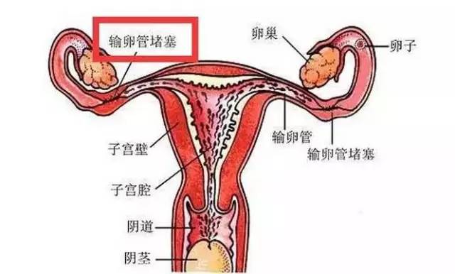 二胎怀不上，80%是因为输卵管堵塞 