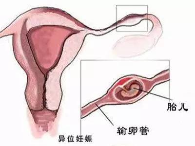 输卵管堵塞怀孕到底有多难？ 
