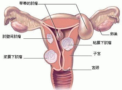 你知道易患宫外孕的人群有哪些吗?