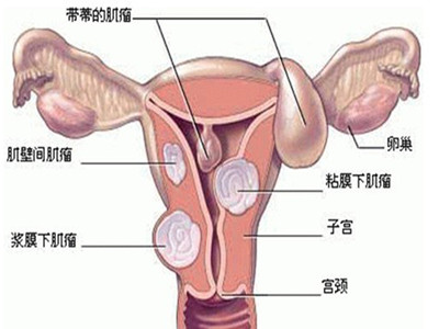 子宫肌瘤治疗的有效方法有哪些
